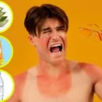 ¿Cómo aliviar los síntomas de las quemaduras por el sol?